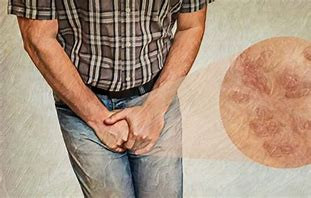 بهبود زگیل تناسلی